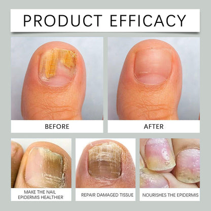 Nail Fungus Treatment Liquid Repair Damaged Foot Strengthen Cuticle Nourishing Tea Tree Ginger Anti Infection Nail Care Solution